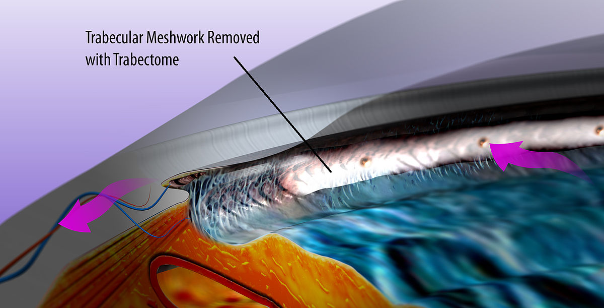  Trabectome procedure